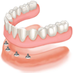 Benefits of Implant Supported Dentures