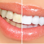 Teeth Whitening Myths