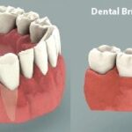Dental Implant Vs. Fixed Bridge – Which Is Best?